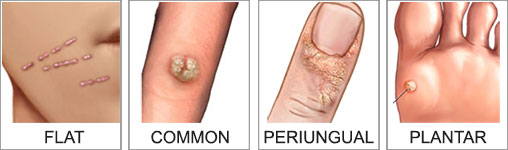 home remedy for wart removal